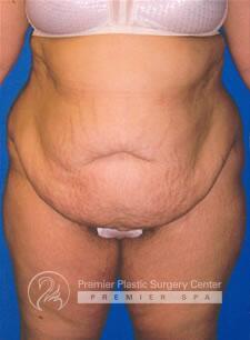 Skin Removal After Weight Loss Before & After Image