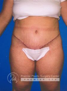 Skin Removal After Weight Loss Before & After Image