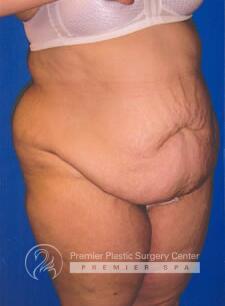 Skin Removal After Weight Loss Before & After Image