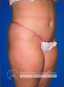 Skin Removal After Weight Loss Before & After Image