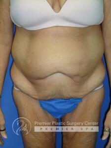 Skin Removal After Weight Loss Before & After Image