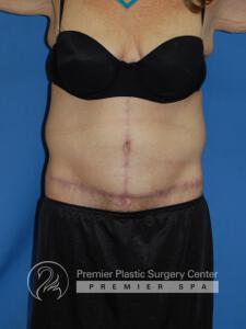 Skin Removal After Weight Loss Before & After Image