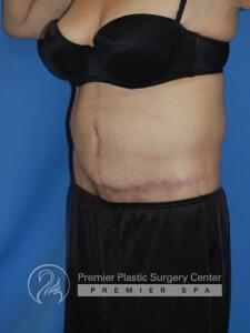 Skin Removal After Weight Loss Before & After Image