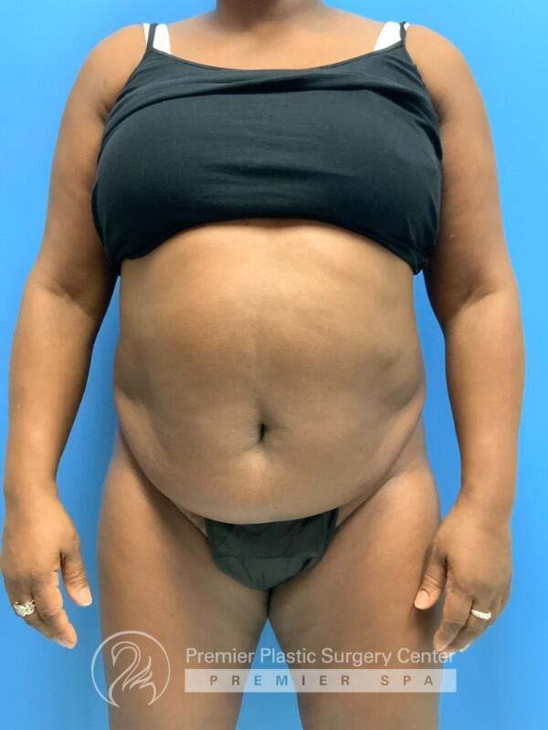 Tummy Tuck Before & After Image