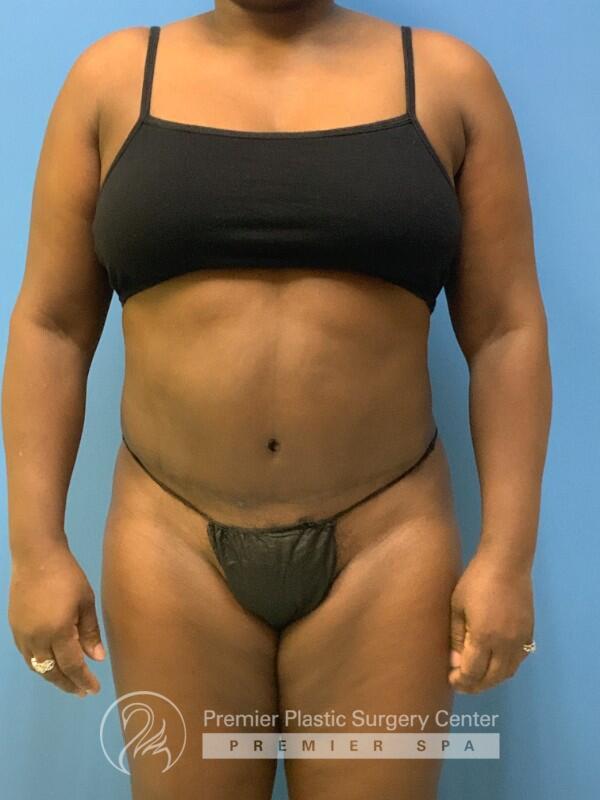 Tummy Tuck Before & After Image