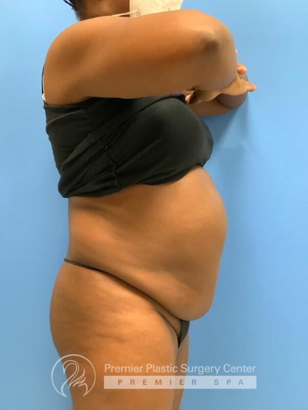Tummy Tuck Before & After Image