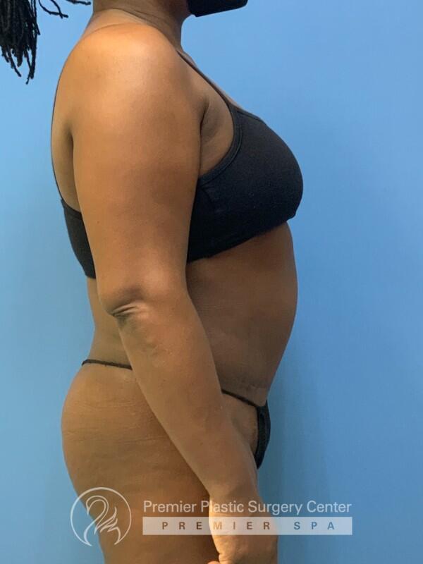 Tummy Tuck Before & After Image
