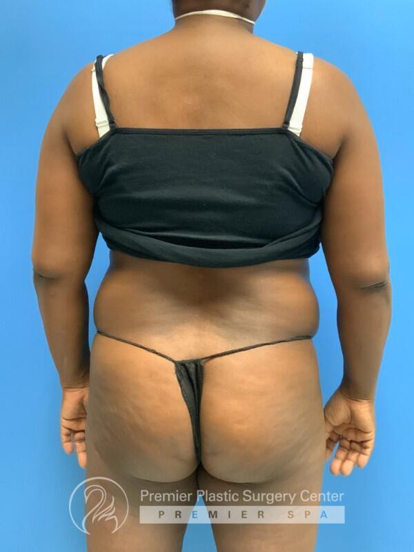 Tummy Tuck Before & After Image