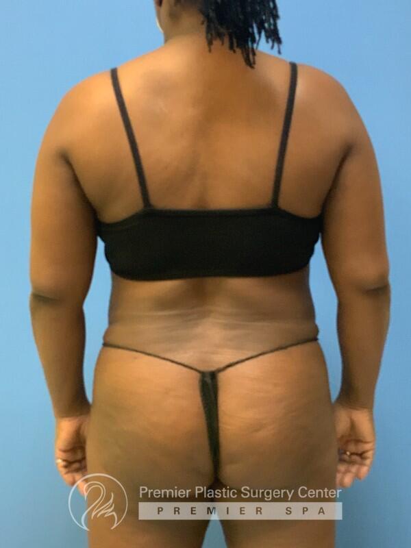 Tummy Tuck Before & After Image