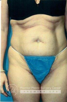 Tummy Tuck Before & After Image