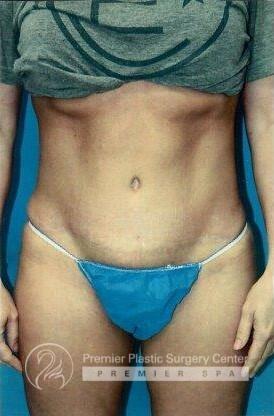 Tummy Tuck Before & After Image