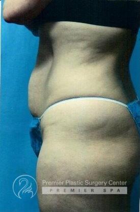 Tummy Tuck Before & After Image