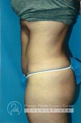 Tummy Tuck Before & After Image