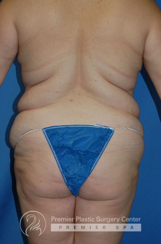 Tummy Tuck Before & After Image