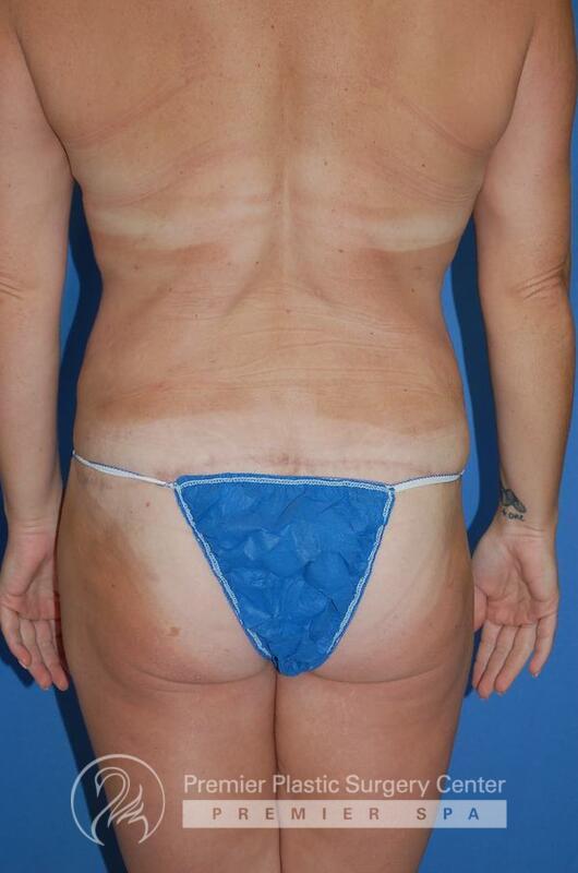 Tummy Tuck Before & After Image