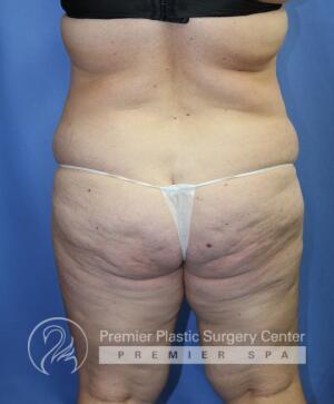 Tummy Tuck Before & After Image