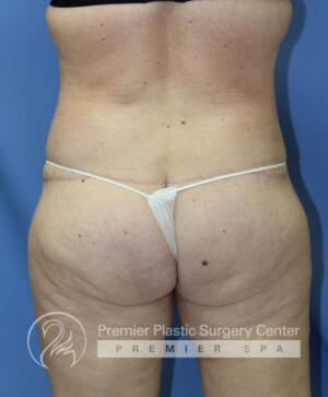 Tummy Tuck Before & After Image