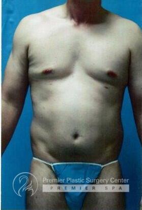 Tummy Tuck Before & After Image