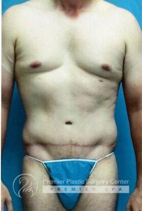 Tummy Tuck Before & After Image