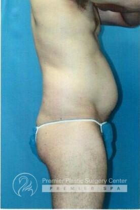 Tummy Tuck Before & After Image
