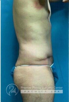 Tummy Tuck Before & After Image