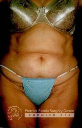 Tummy Tuck Before & After Image