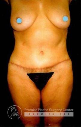 Tummy Tuck Before & After Image