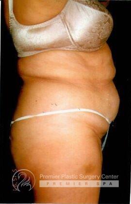 Tummy Tuck Before & After Image