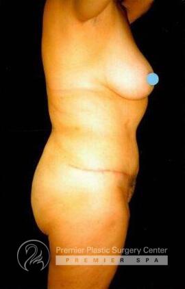 Tummy Tuck Before & After Image