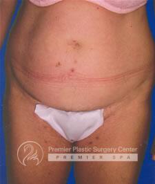Tummy Tuck Before & After Image