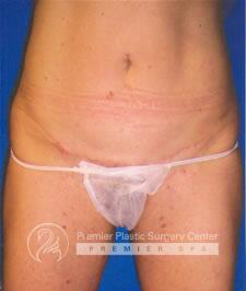 Tummy Tuck Before & After Image