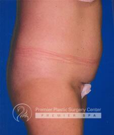 Tummy Tuck Before & After Image