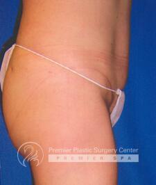 Tummy Tuck Before & After Image