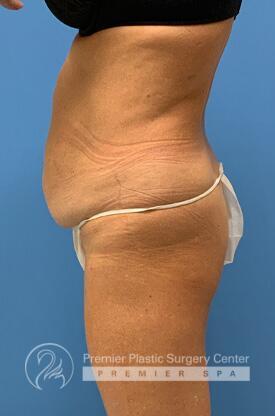 Tummy Tuck Before & After Image
