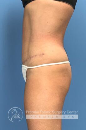 Tummy Tuck Before & After Image