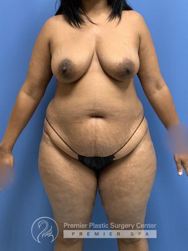 Tummy Tuck Before & After Image