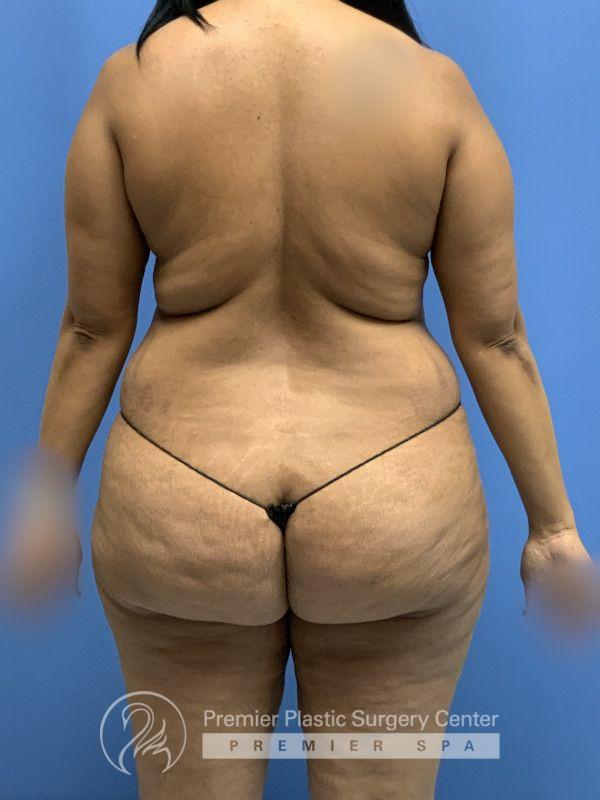 Tummy Tuck Before & After Image