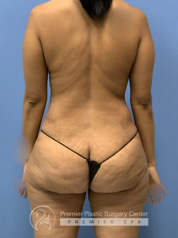 Tummy Tuck Before & After Image