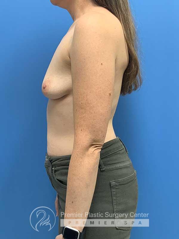 Breast Augmentation Before & After Image