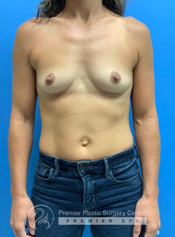 Breast Augmentation Before & After Image