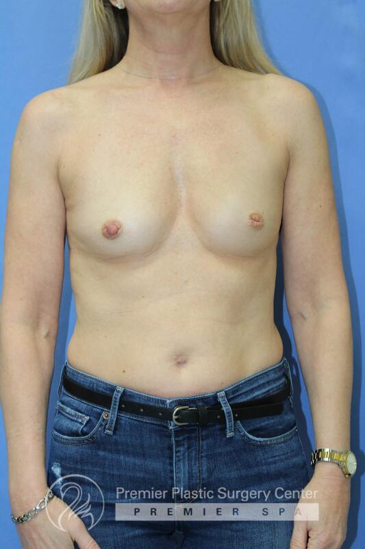 Breast Augmentation Before & After Image
