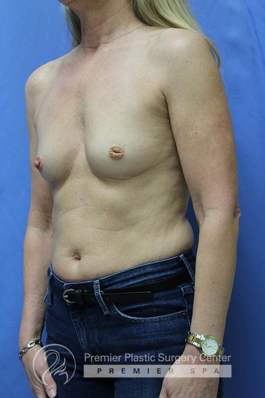 Breast Augmentation Before & After Image