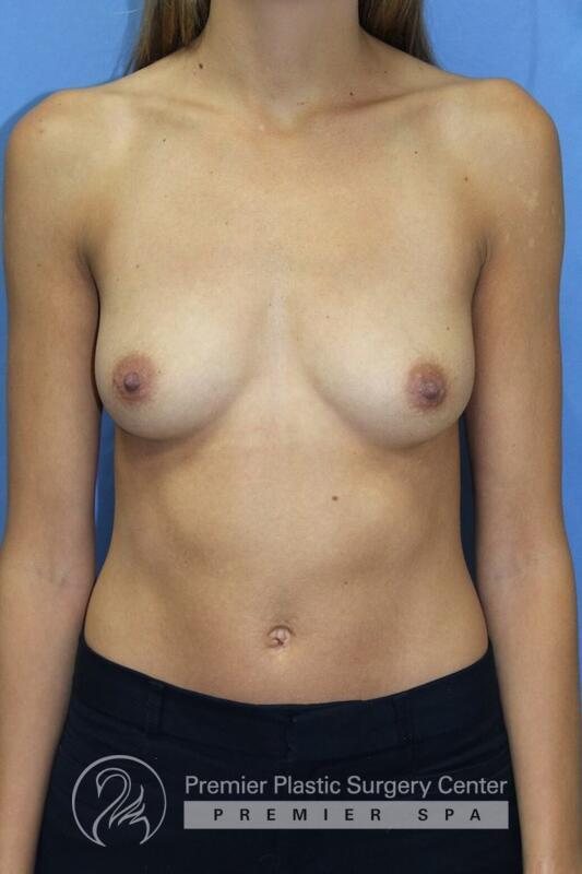 Breast Augmentation Before & After Image