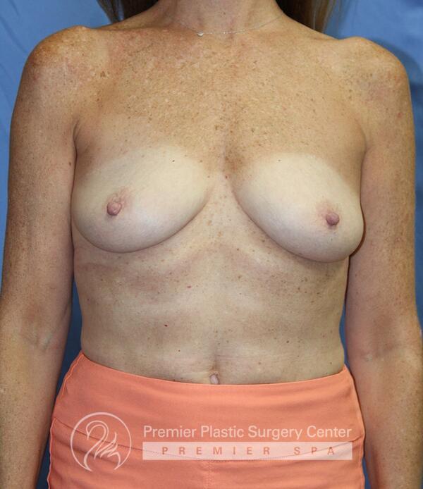 Breast Augmentation Before & After Image