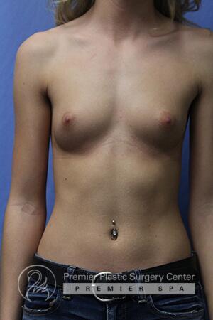 Breast Augmentation Before & After Image