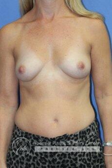 Breast Augmentation Before & After Image