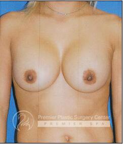 Breast Augmentation Before & After Image
