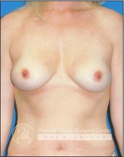 Breast Augmentation Before & After Image
