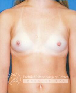 Breast Augmentation Before & After Image