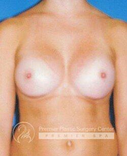 Breast Augmentation Before & After Image